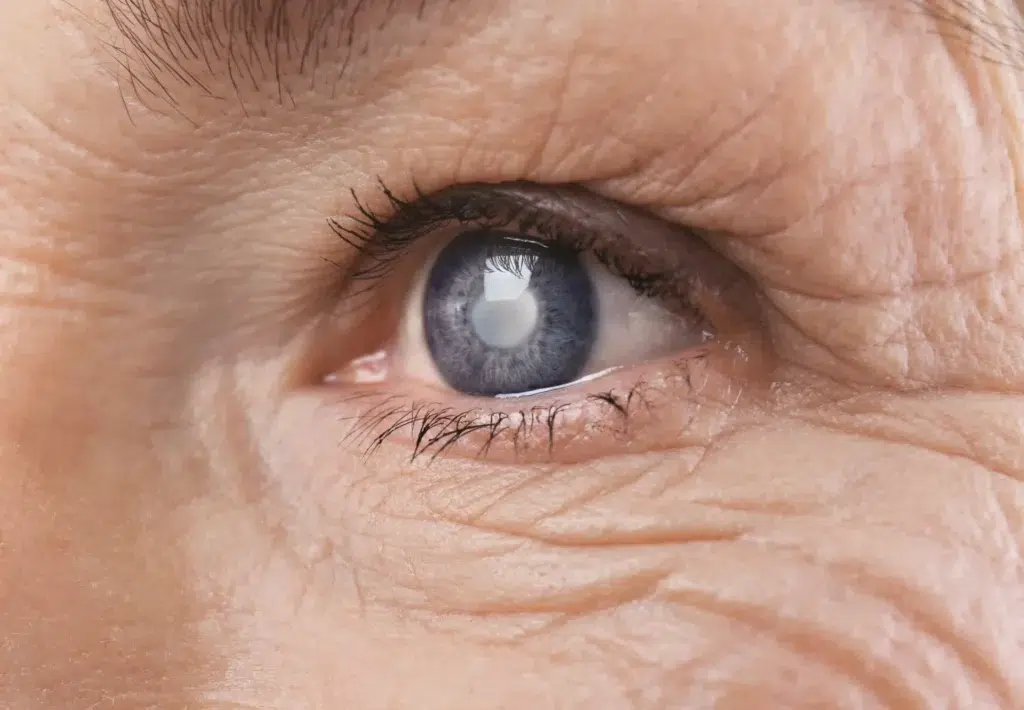 What Is The First Sign Of Cataracts?