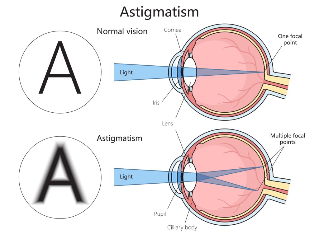 Graphic of how light enters a normal eye versus one with astigmatism