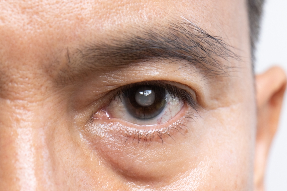 Close-up of a man with cataracts clouding over his eye, in need of corrective surgery for improved vision.