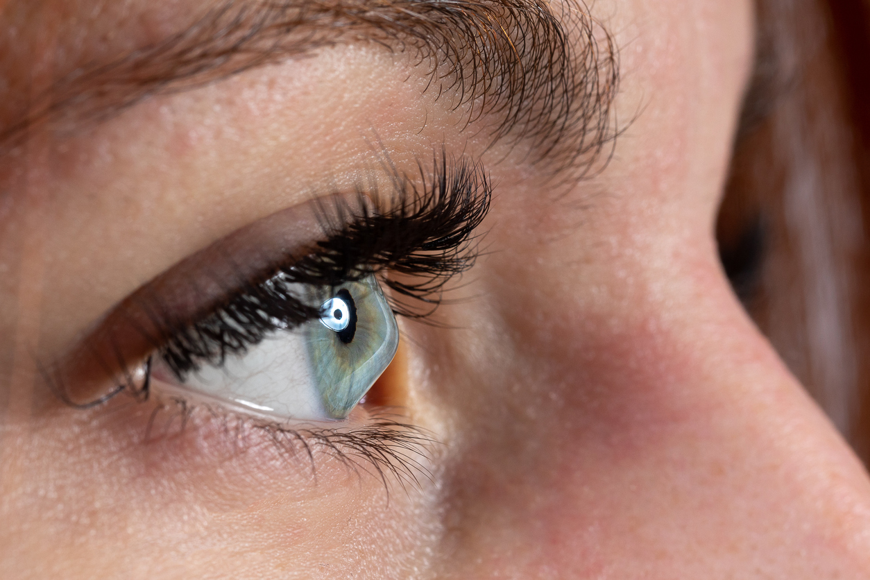 Close-up of a woman's eye, suffering from keratoconus from gradual cornea thinning over time.